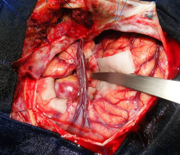 Operacja mózgu w celu usunięcia olbrzymiego tętniaka.